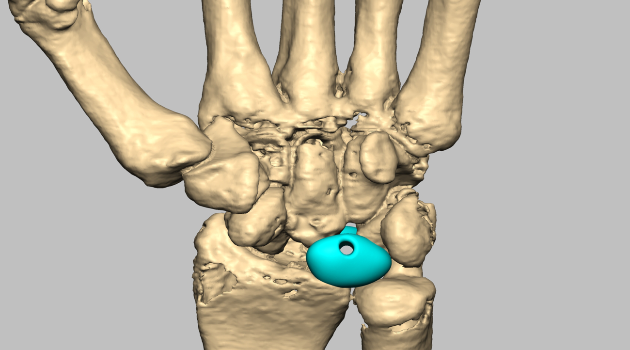 CADskills' first 3D printed lunate replacement with ligament reconstruction