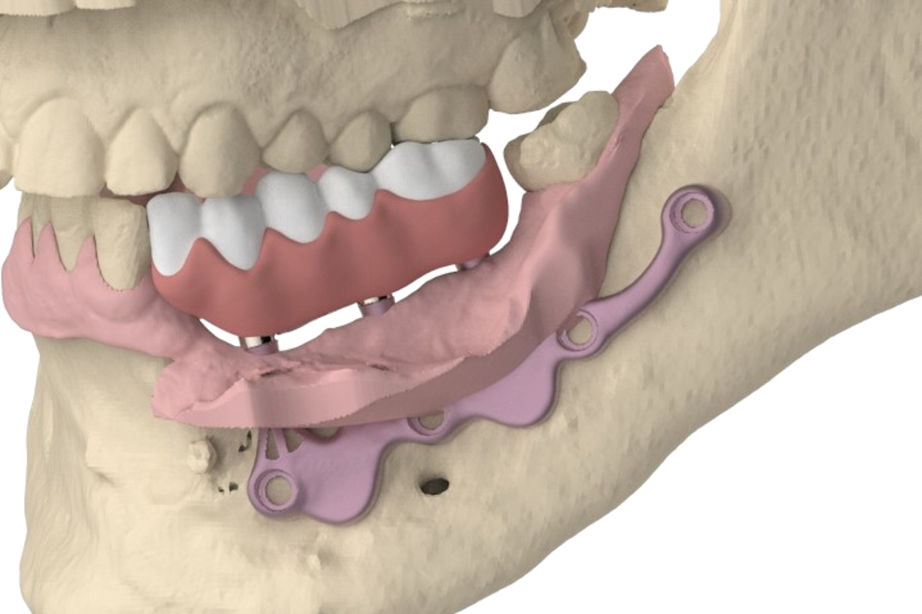 El concepto AMSJI®, no solo una solución adecuada para la mandíbula edentada completa