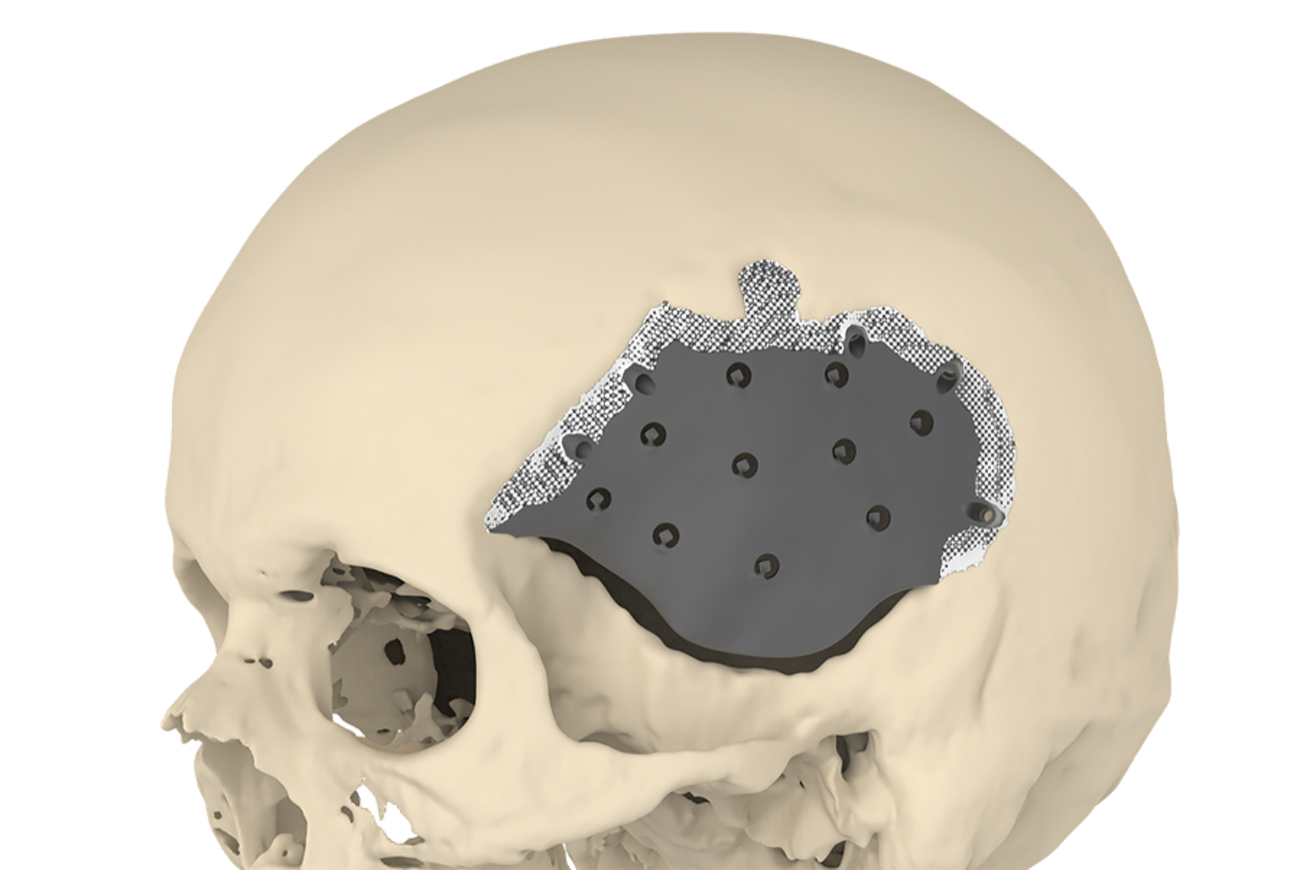 A novel implant enhances skull surgery outcomes