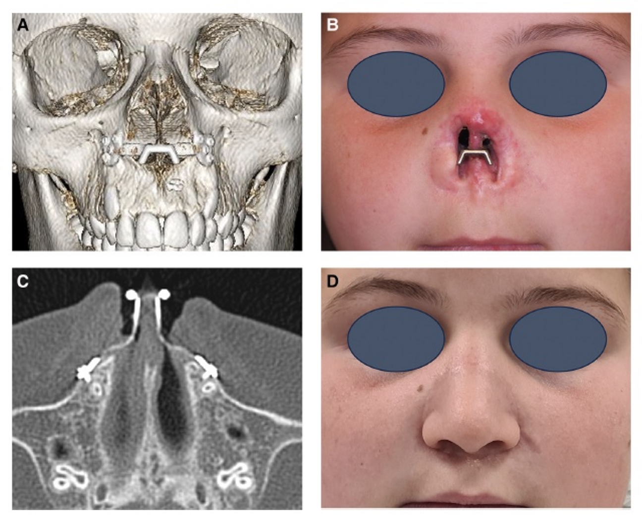 Pediatric nose reconstruction on PSI