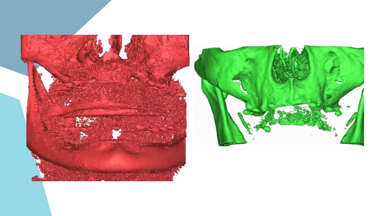 Segmentation and quality of C(BC)T scan