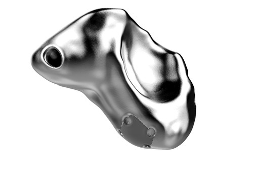Patient-Specific Scaphoid Replacement: A Case Report