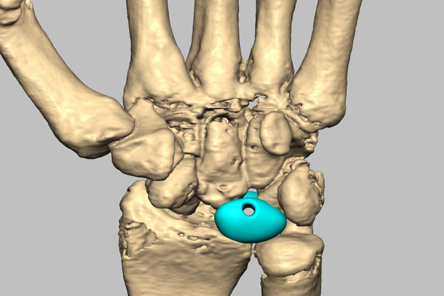 CADskills' first 3D printed lunate replacement with ligament reconstruction