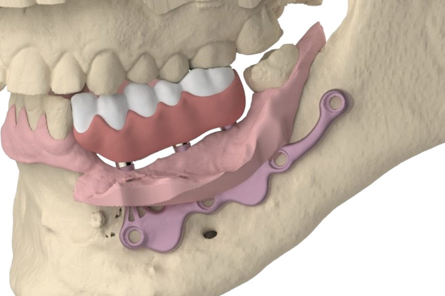 The AMSJI® concept, not only a suitable solution for the full edentulous jaw