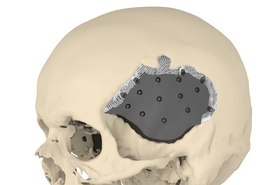 A novel implant enhances skull surgery outcomes