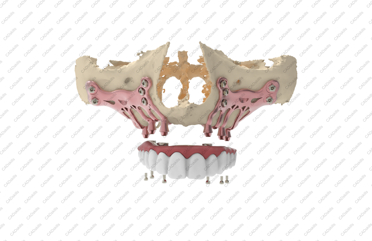 AMSJI®™, an implant-prosthetic solution