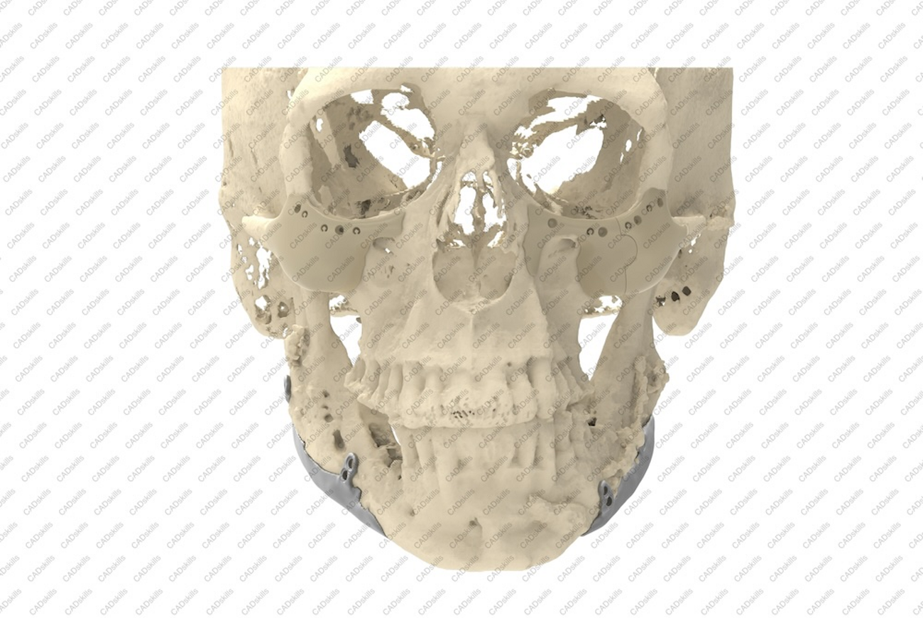 FACIAL CONTOURING IMPLANTATER