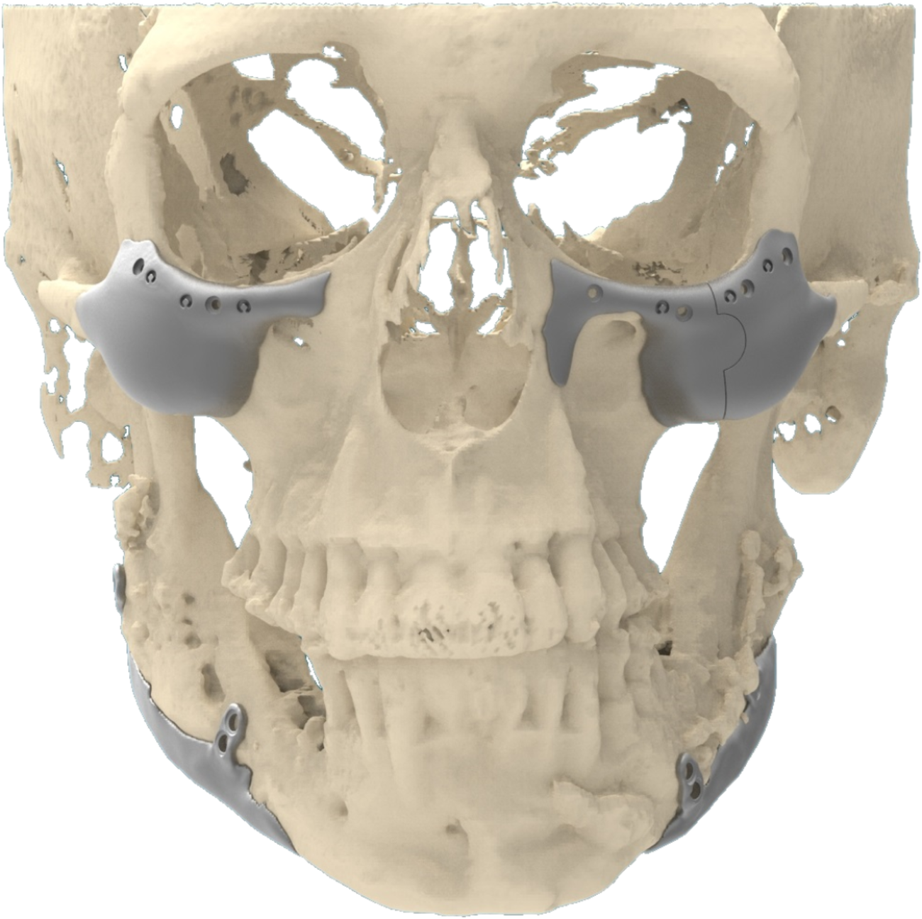 Facial Contouring Implants