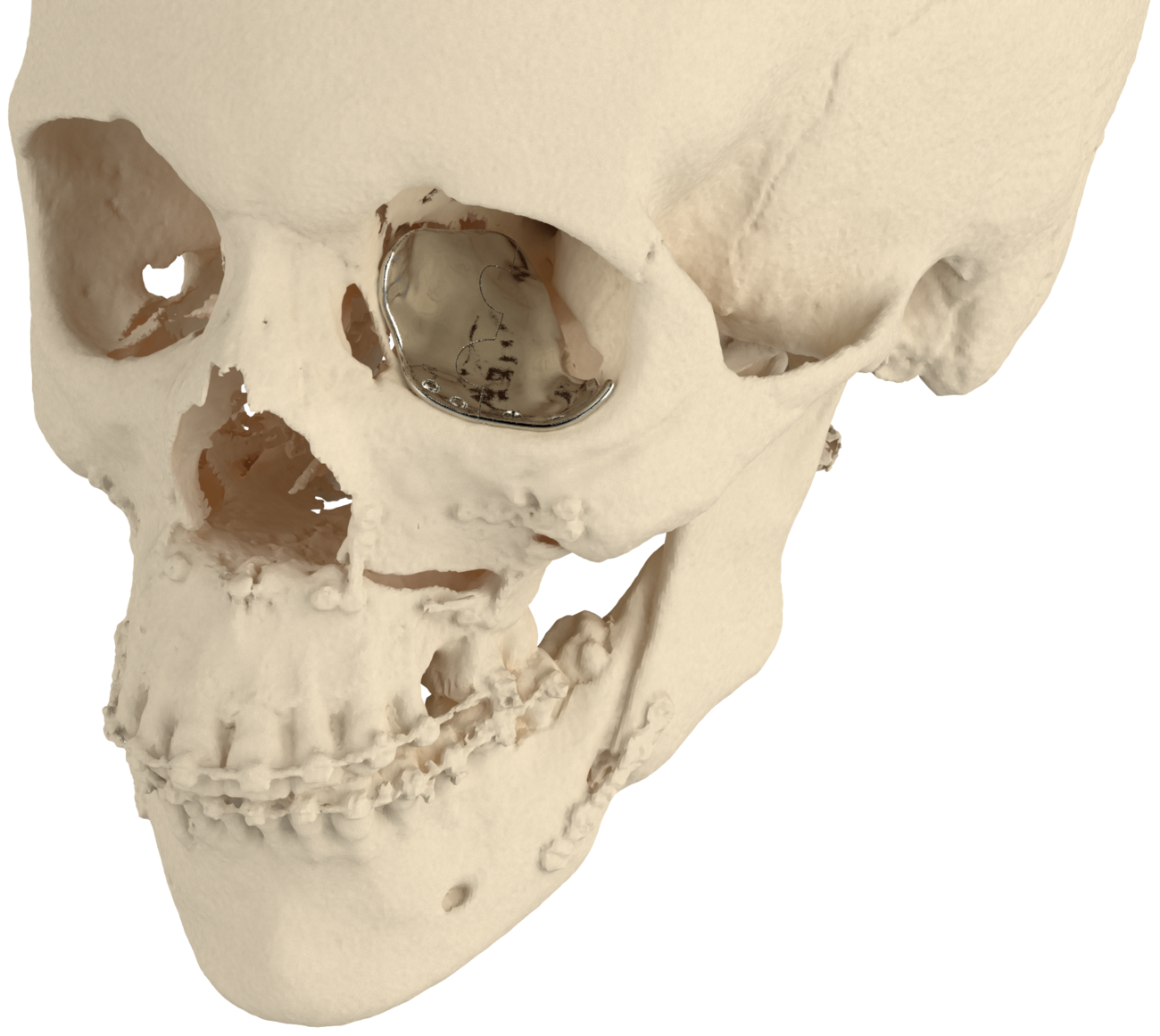 Reconstruction de la paroi orbitaire dans le cadre d'implants de contour du visage