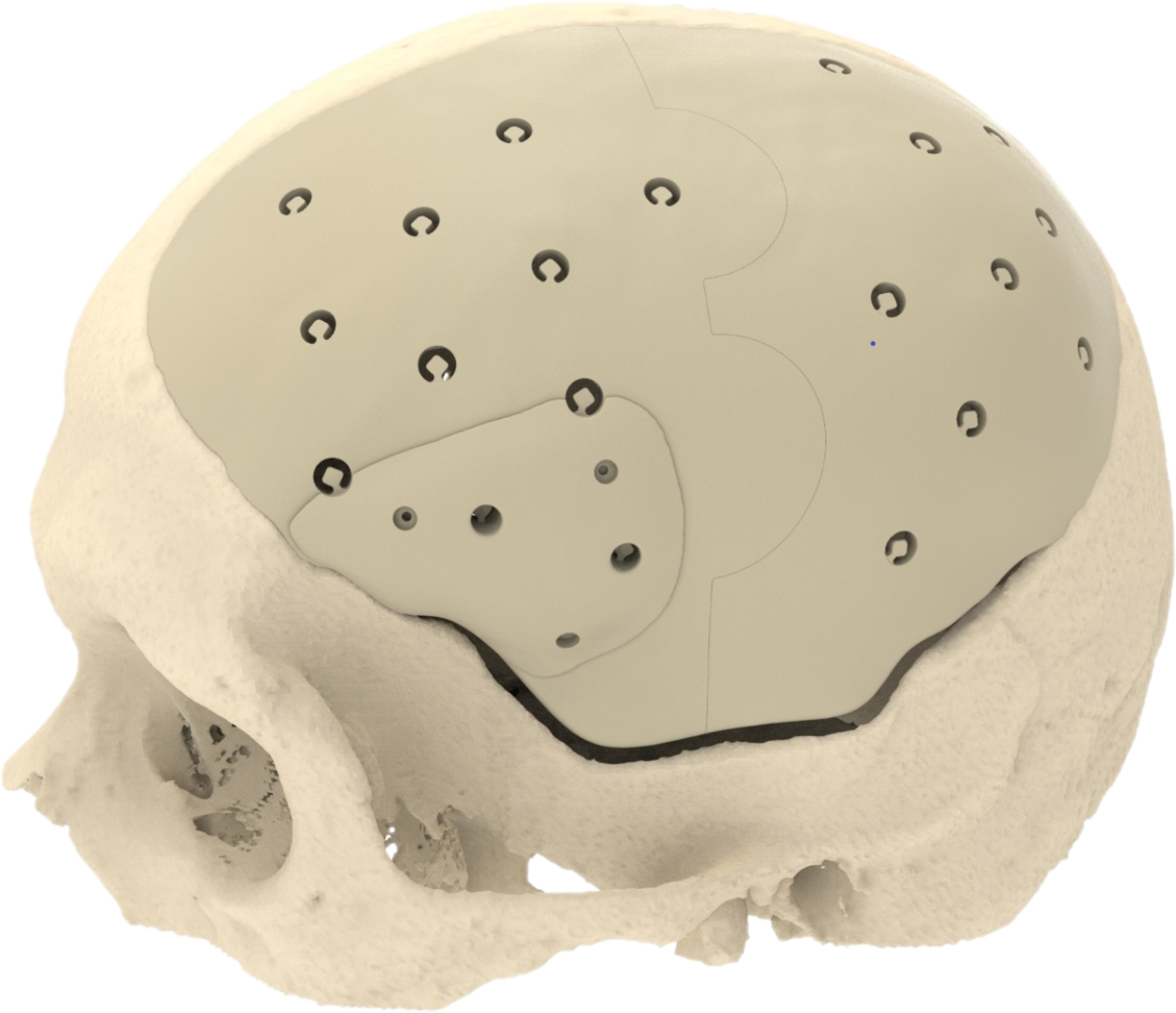 Cranioplastiche