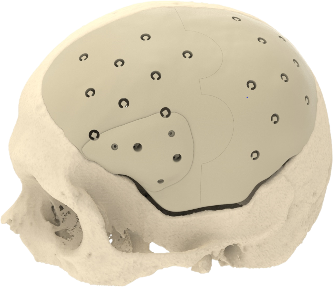 CRANIOPLASTY
