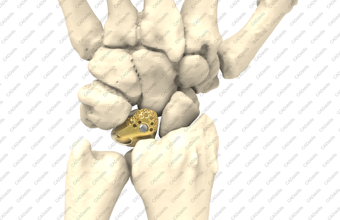 SCAPHOID REPLACEMENT