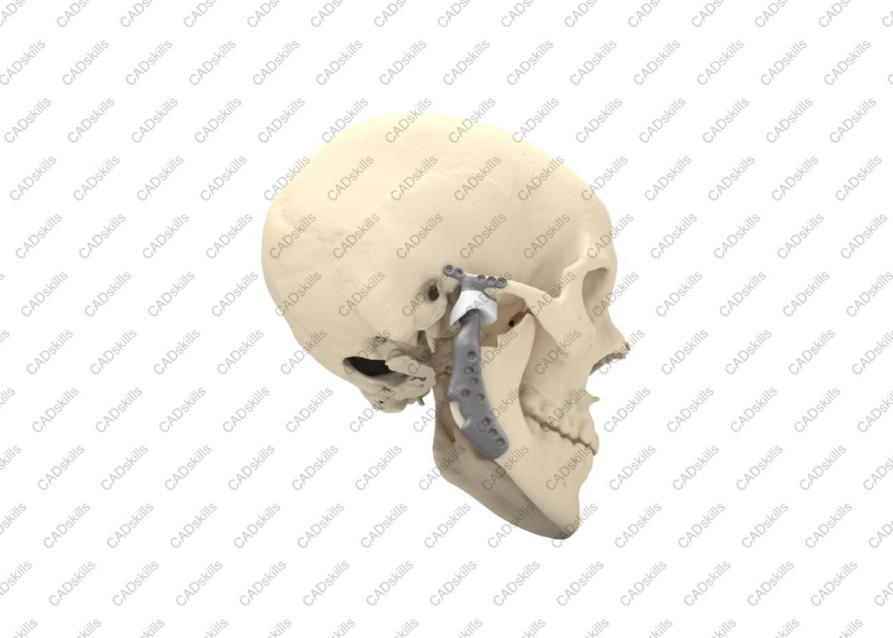 tmj-implant-patient-concept-cadskills